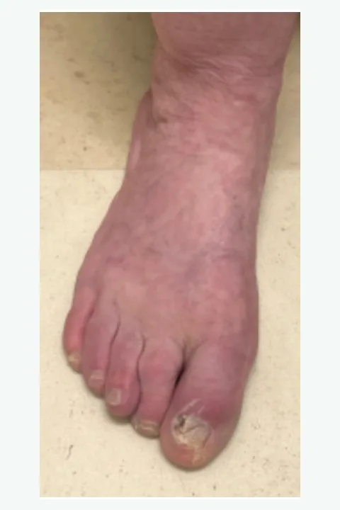 After: reconstructed forefoot