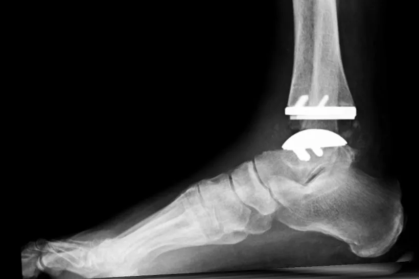 After: total ankle replacement, lateral X-ray