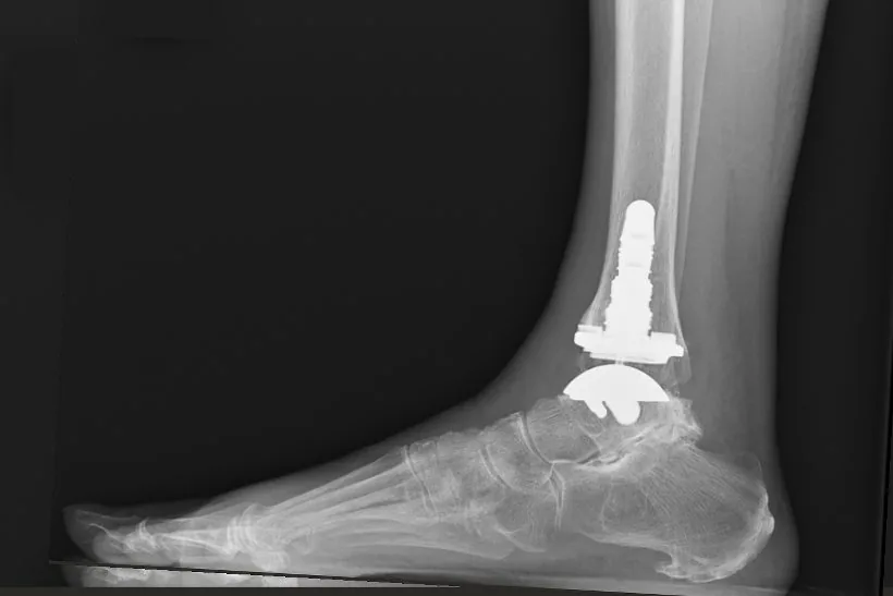 After: total ankle replacement, weight-bearing X-ray