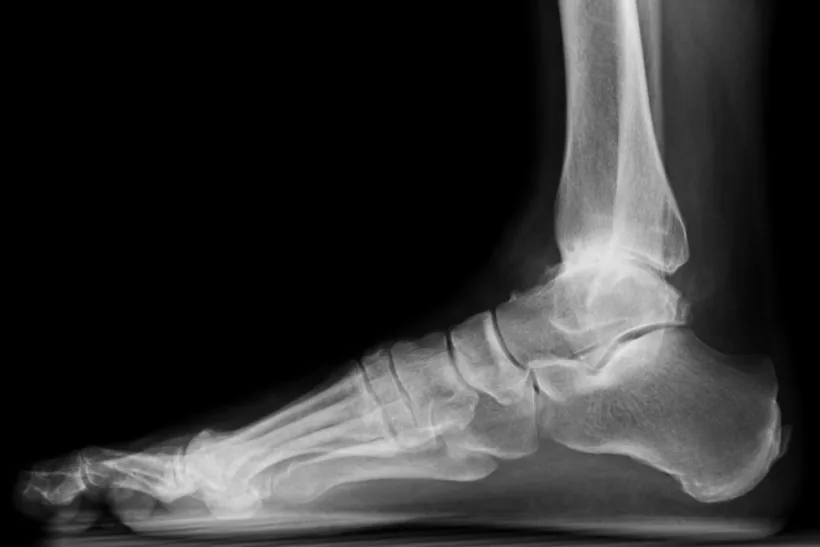 Before: ankle arthritis, lateral X-ray