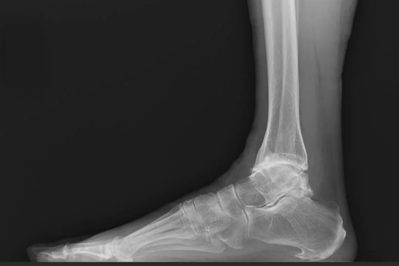 Before: end-stage ankle arthritis, X-ray