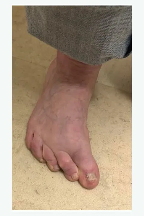 Before: forefoot deformity